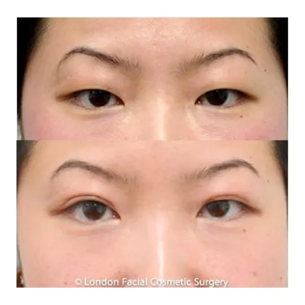 Asian blepharoplasty before and after, woman in her 20s