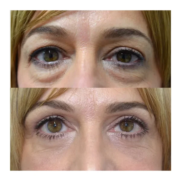 Upper and lower blepharoplasty before and after, woman in her early 50s