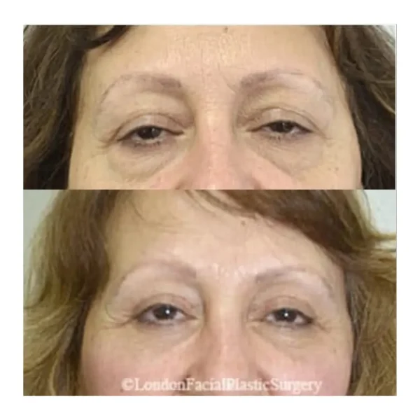 Upper and lower blepharoplasty before and after, woman aged 60