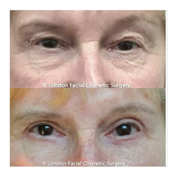 Upper and lower blepharoplasty with fat transfer before and after, woman in her 60s