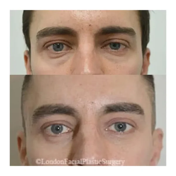 Lower blepharoplasty before and after, man under 30