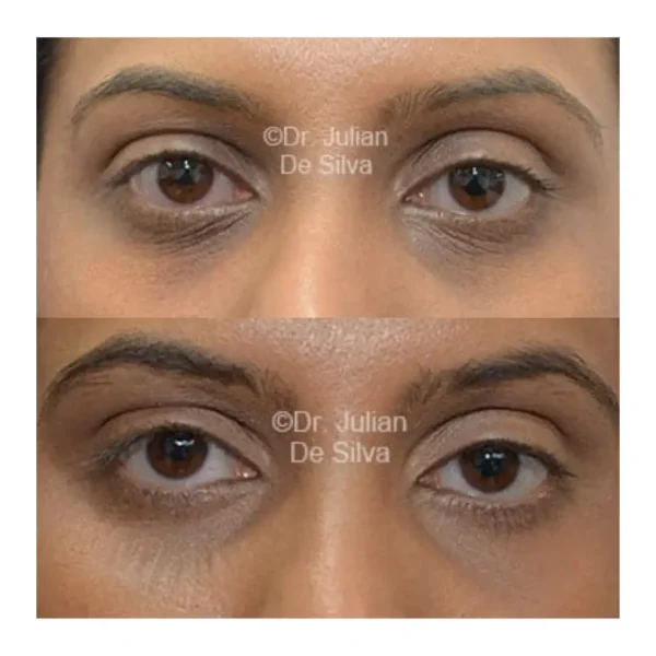 Lower blepharoplasty before and after, woman in her 30s