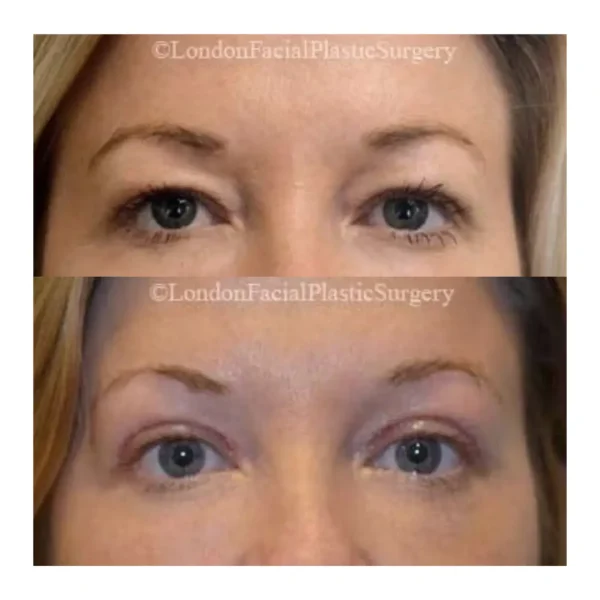 Upper blepharoplasty before and after, 1 week after surgery