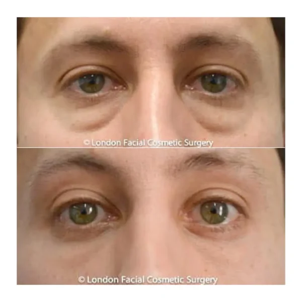 Hidden-incision lower blepharoplasty before and after, young man