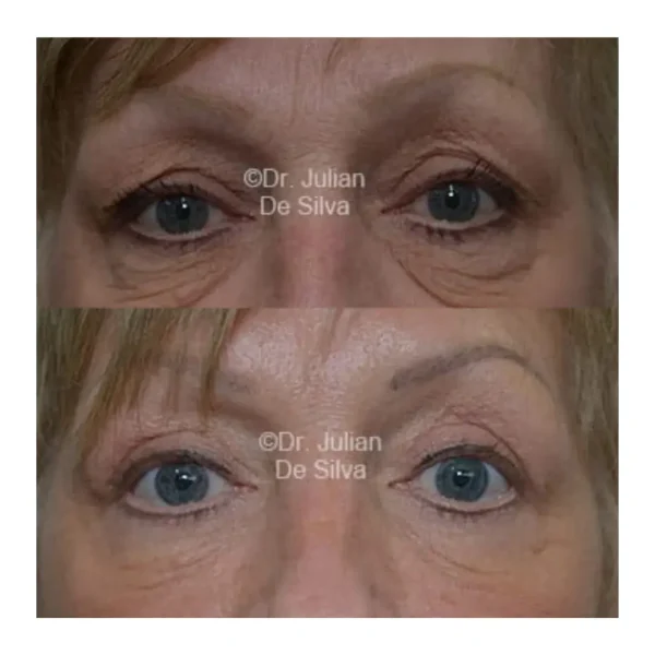 Blepharoplasty for lower eyelid festoons before and after, woman in her early 60s