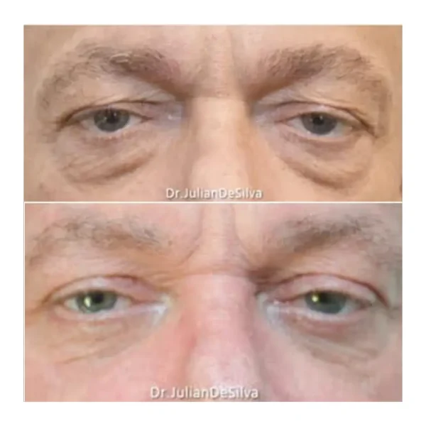 Upper and lower blepharoplasty before and after, man in his 50s