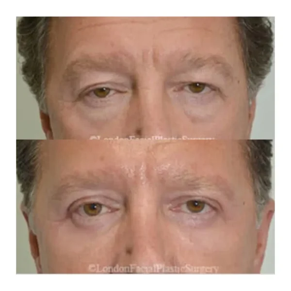 Upper and lower blepharoplasty before and after, man in his 50s
