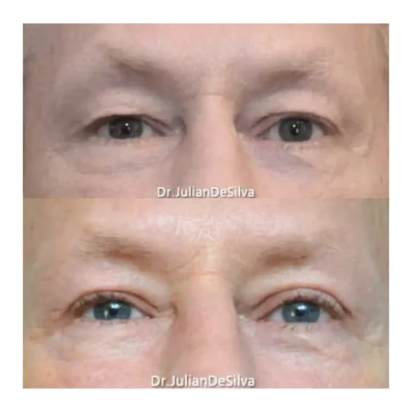 Upper blepharoplasty before and after, man aged 56